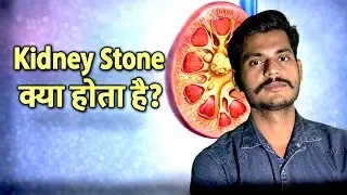 Kidney stone (pathri) ka Size Kitna ho to Khud Nikalti Hai? | Kidney Stone Explained in Hindi