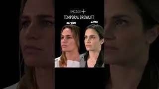Browlift Before and After