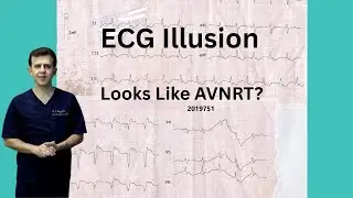 24: ECG Illusion, Looks Like AVNRT?