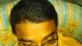 How to maintain after hair transplant | hair heal talks.