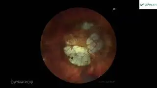 Myopic CNVM  - Heidi Mina - 2024 12 13