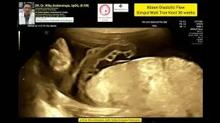 Absen diastolik Umbilical Blood flow - Simpul mati true knot 30 weeks.