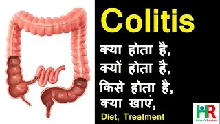 Colitis symptoms, causes and treatment in Hindi || Complete information about colitis