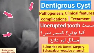 Dentigrous cyst @akdentist | tooth eruption cyst | follicular cyst |
