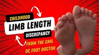 Childhood Limb Length Discrepancy: From The DMs, Episode 6