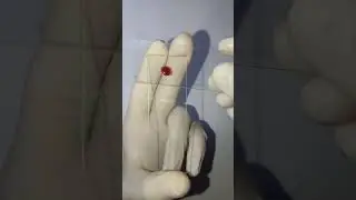 peripheral blood smear | blood test