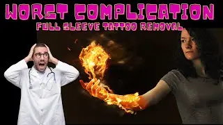 The Laser Tattoo Removal Complication You Don&rsquo;t Want : Dr. Undo Tattoo