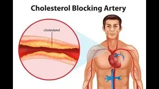 Hypercholesterolemia (High Cholesterol) ; Definition, Causes, Types, Symptoms, Diagnosis, treatment