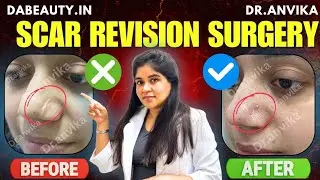 Scar transformation journey II BEFORE AFTER RESULTS II #dranvika #skincare #skincaretipsinhindi 