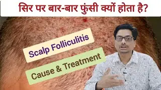 सिर पर बार-बार फुंसी क्यों होता है? Scalp Folliculitis | Cause & Treatment | सिर पर फोड़े itchy Scalp