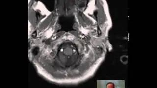 40yoF Brain Tumor CT-MRI DISCUSSION