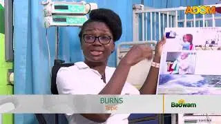 Health Tips: Prevention of Burns - End Point Homeopathic clinic (23-12-25)