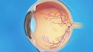 Detached Retina: Pneumatic Retinopexy
