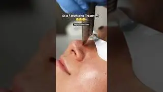 Skin Resurfacing for Texture Improvement | Fotona Erbium Laser | Sydney Clinic