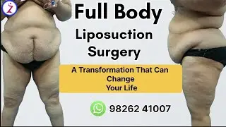 Liposuction in Kolkata | Liposuction Surgery Cost In Kolkata | Zenith Clinic