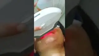 Facial Hair Removal by Laser in a Patient with Hirsutism | Permanent Hair Growth Reduction
