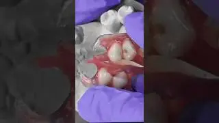 🦷 &iexcl;PR&Oacute;TESIS FLEXIBLE EIKER: COMODIDAD Y EST&Eacute;TICA EN UN SOLO DISE&Ntilde;O! #Mundialdent