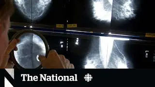 Canada&rsquo;s cancer screening guidelines are out of date, doctors say