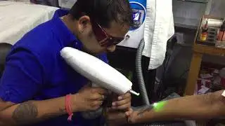#Permanent tattoo #removal in Raipur # 9589557355