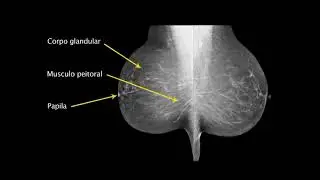 Atualiza&ccedil;&atilde;o de T&eacute;cnicos em Mamografia (INCA): Incid&ecirc;ncia Rotineira m&eacute;diolateral obl&iacute;qua MLO