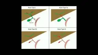 Kasai Procedure types Portoenterostomy #doctor #shortsfeed #short #short #shortsvideo