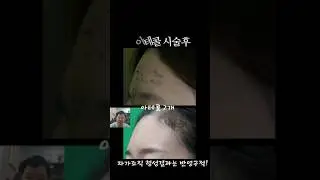 꺼진 이마의 아테콜 융기#연세자연미성형 #반영구필러 #벨라필  #신촌성형외과 #홍대성형외과 #은평성형외과 #마포성형외과 #이마보형물부작용#이마지방이식