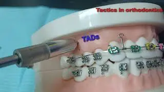 TADS for retraction of upper canine