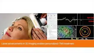 Nexstim SmartFocus&reg; TMS&mdash;a new treatment for neuropathic pain (short video)