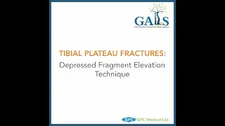 Tibial Plateau Fractures: Depressed Fragment Elevation Technique | GAITS Academy