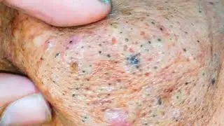 sac be spa blackheads elderly new | sac be spa men age blackheads new 2026 | sac be spa face scrub 