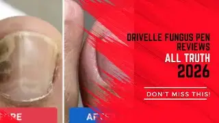 Orivelle Fungus Pen Reviews 2026 Is It Legit? I Tested Orivelle Fungus Pen... Here&rsquo;s What Happened