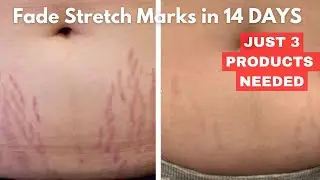 HOW TO CLEAR STRETCH MARKS IN 14 DAYS | Just 3 Products Needed