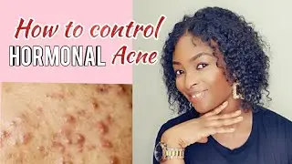 HOW TO CONTROL HORMONAL ACNE | TEMIBLOGTV