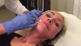 Bioristrutturazione viso con Viscoderm Hydrobooster - Patrizia Piersini