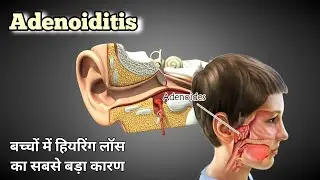 बच्चों के कान बंद? एडेनोइड इन्फेक्शन छीनता है सुनने की ताकत | Adenoiditis & Hearing Loss in children
