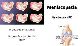Rehabilitación luego de una lesión de los meniscos. (Prueba de Mcmurray). Fisioterapia RD