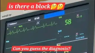 Comment down your diagnosis? #cardiology #ecg #ekg #medicine ##medico ##nursing 