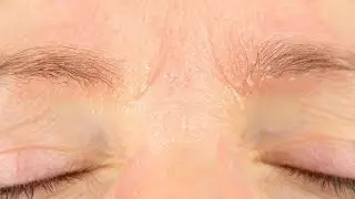 Why Do My Eyebrows Itch and Flake During the Winter?