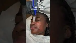 SkinPen Huidbehandeling op Donkere Huid | Almere Amsterdam Eindhoven | The Laser Company