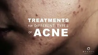 Acne Treatment in Singapore for Different Types of Acne | Dr Chiam CT