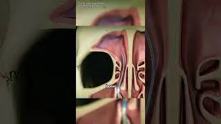 Sinus Surgery for Sinusitis (3D Animation)#sinussurgery #sinusitis #ent #nasalsurgery #medical3d