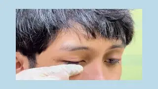 WTF!(WHAT THE FACT!): EYELID CLEANING
