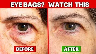 Doctors Explain: Why Under-Eye Puffiness Gets Worse After 60 (And the 4-Step Fix)