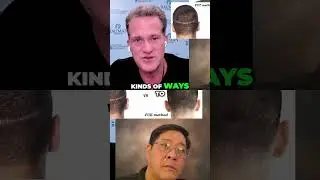 #1 FUE Hair Transplant  99% Regrowth Explained!