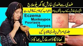 How to Treat Skin Allergies at Home | Eczema | Psoriasis | Monkeypox | Kharish Ka Fori Ilaj