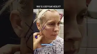 Is Deep Plane Neck Lift Right For You #shorts #necklift #facelift #deepplanenecklift