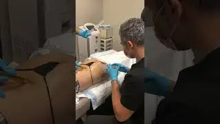 Monster Zombie BBL. 20 vials of sculptra & 12 syringes of PRP, making this the ultimate bubble butt!