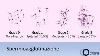 Spermioagglutinazione  Cos'è e come si cura . La lettura dello spermiogramma