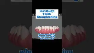 Invisalign Smile Design: Treatment progress of lower teeth straightening.