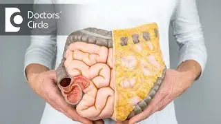 Precautions to be taken against colon cancer - Dr. Anil Kamath